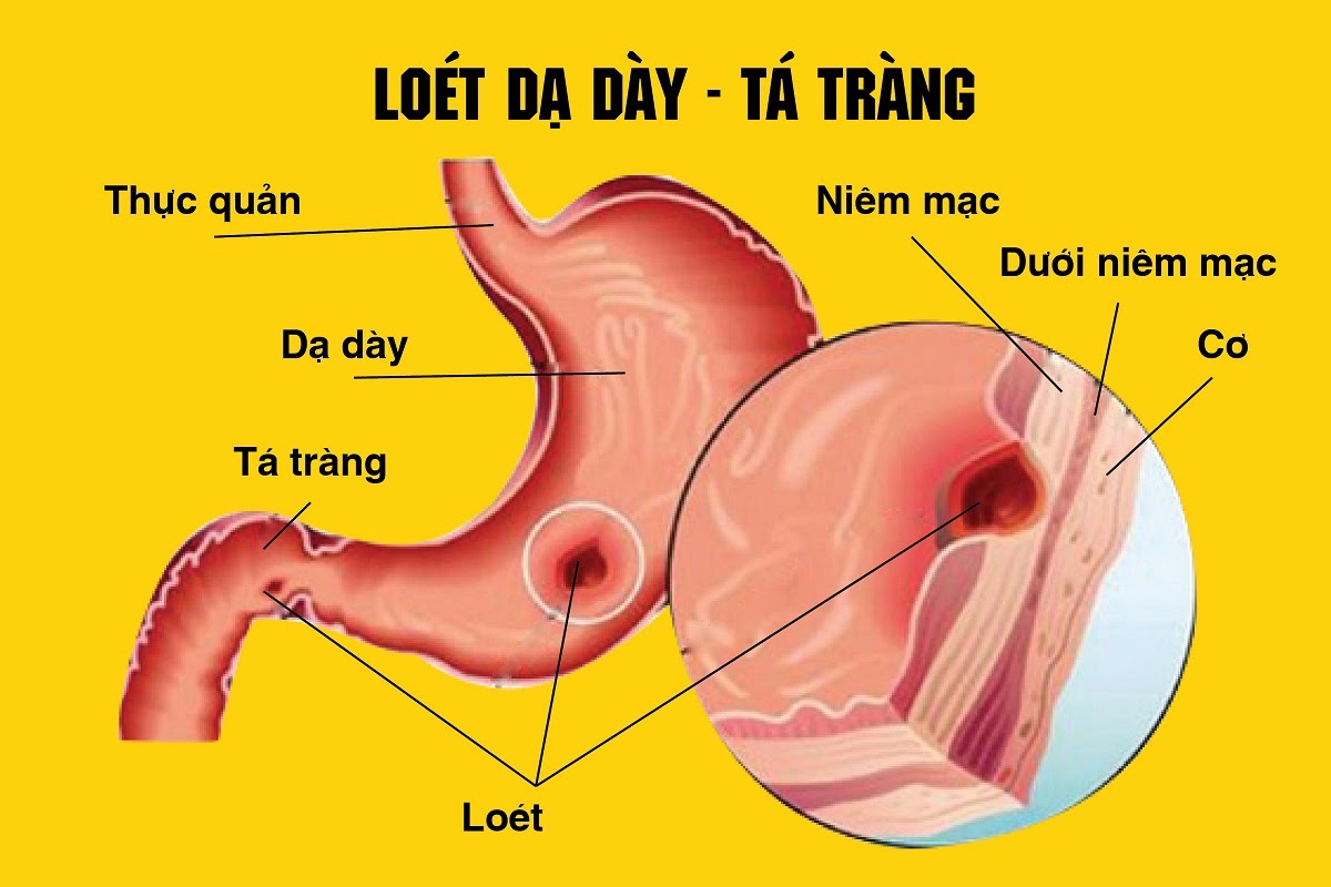 viem-loet-da-day-hanh-ta-trang1