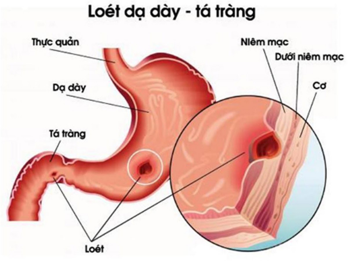viem-loet-da-day-nen-kieng-gi1