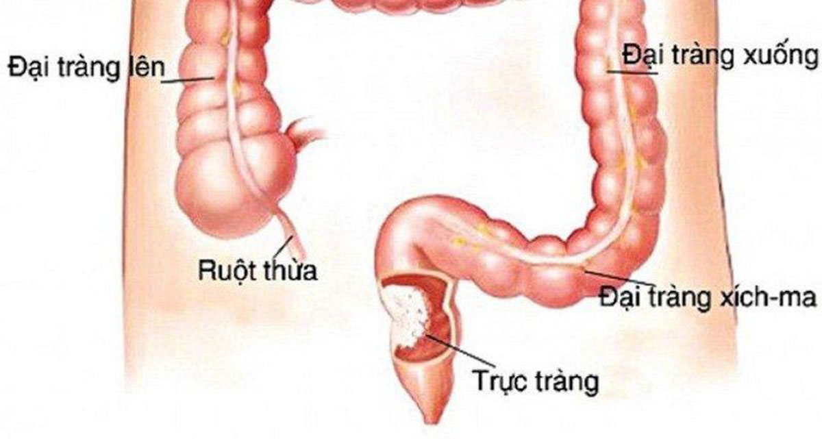 bieu-hien-ung-thu-truc-trang_1