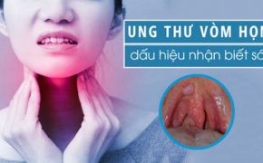 Hình ảnh ung thư vòm họng có mức độ nguy hiểm cao