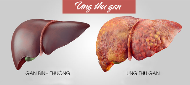 ung-thu-gan_1