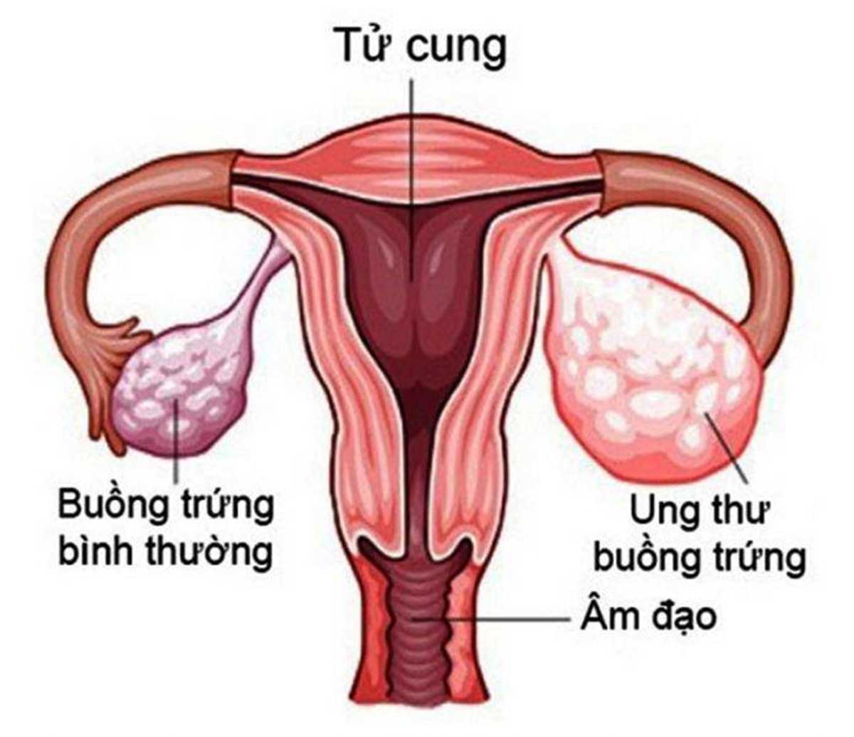 ung-thu-tu-cung-buong-trung_1