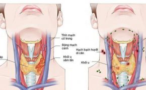 Ung thư hắc tố: Các dấu hiệu thường gặp