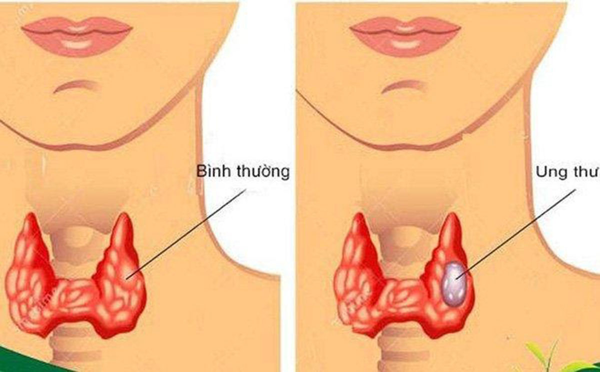 benh-ung-thu-tuyen-giap_1