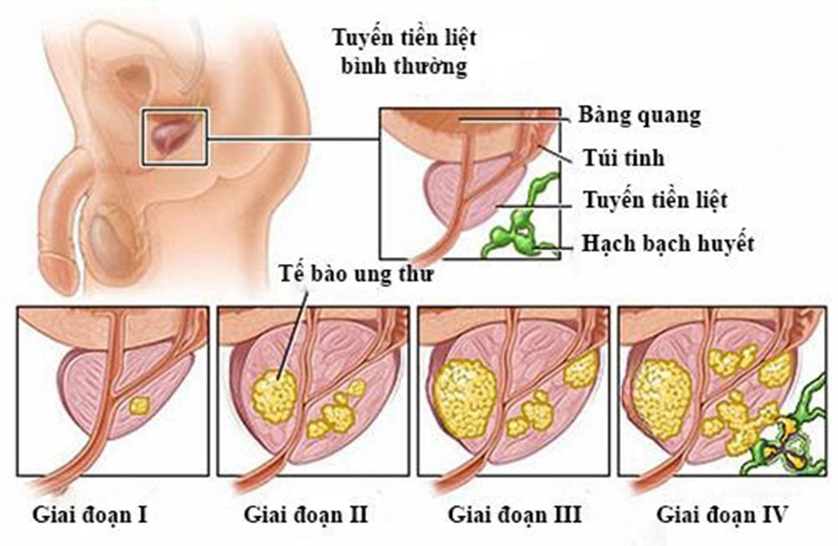 benh-ung-thu-tuyen-tien-liet_1