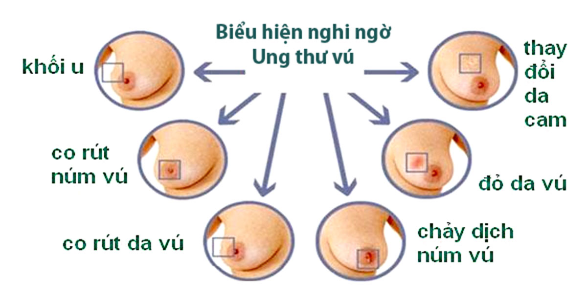 cach-nhan-biet-benh-ung-thu-vu_12