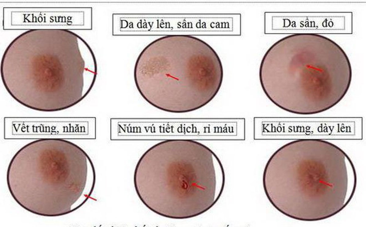 dieu-tri-ung-thu-vu_12