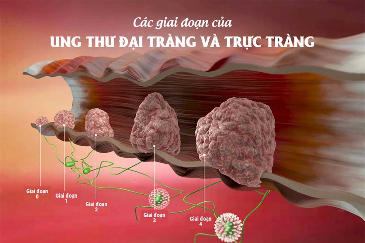 ung-thu-dai-trang-giai-doan-1-1