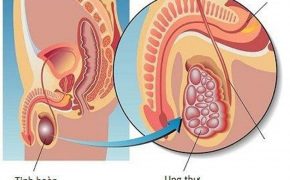 Các triệu chứng ung thư tinh hoàn nam giới cần nắm rõ