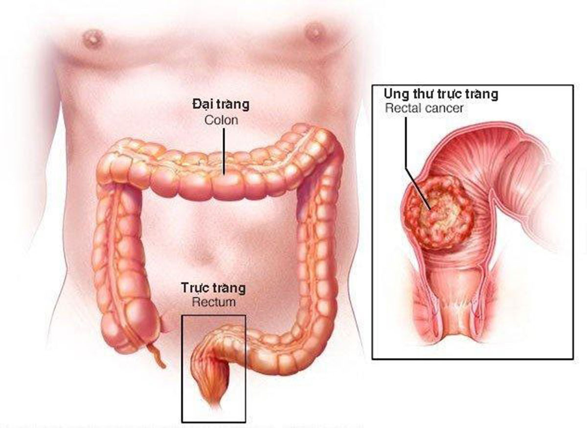 ung-thu-truc-trang-giai-doan-3_1