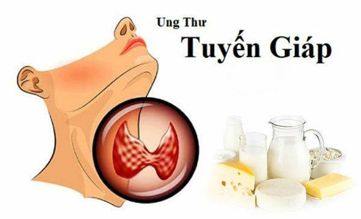 ung-thu-tuyen-giap-nen-an-gi-va-kieng-gi_12