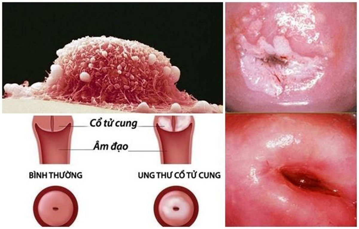 dau-hieu-ung-thu-co-tu-cung_12