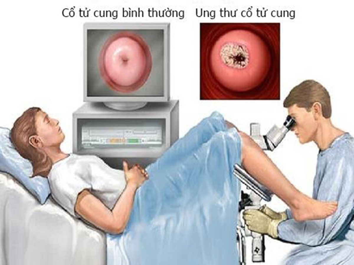 dau-hieu-ung-thu-co-tu-cung_14
