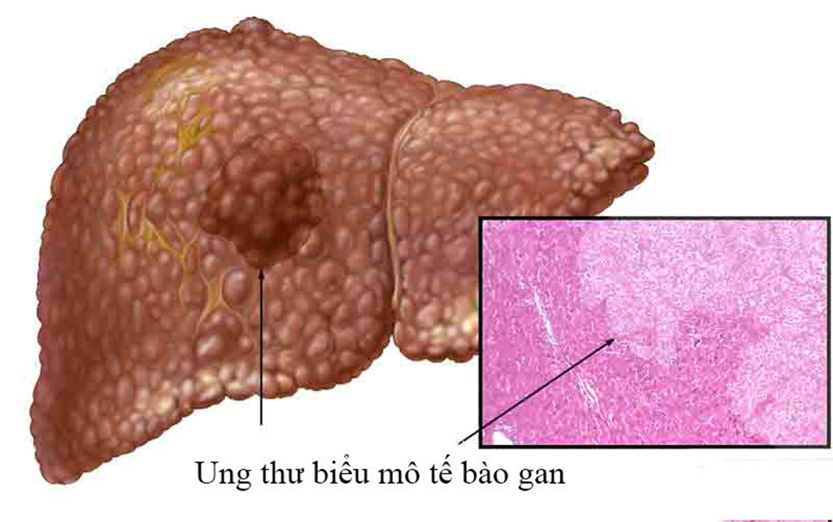 ung-thu-bieu-mo-te-bao-gan_12