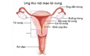 Phương pháp chẩn đoán và điều trị bệnh ung thư nội mạc tử cung