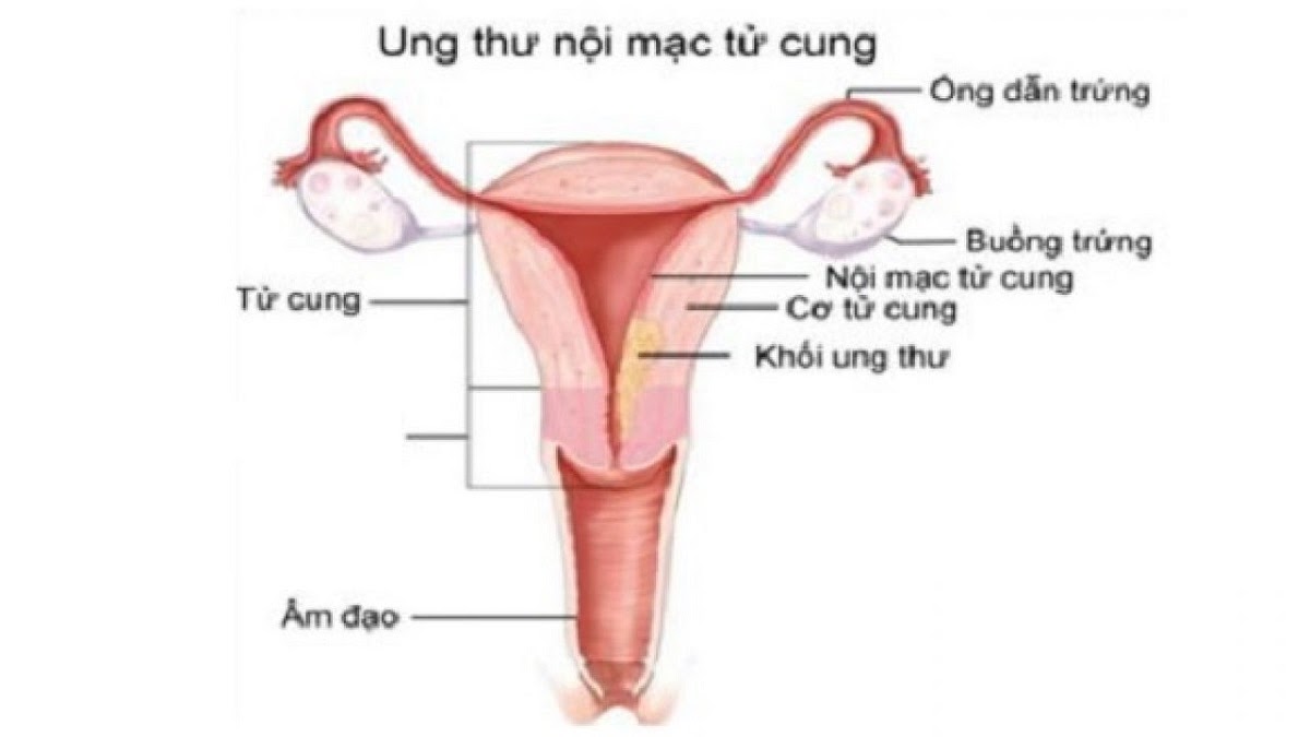 ung-thu-noi-mac-tu-cung1