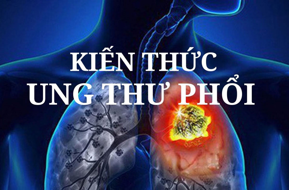 ung-thu-phoi-giai-doan-cuoi-song-duoc-bao-lau2