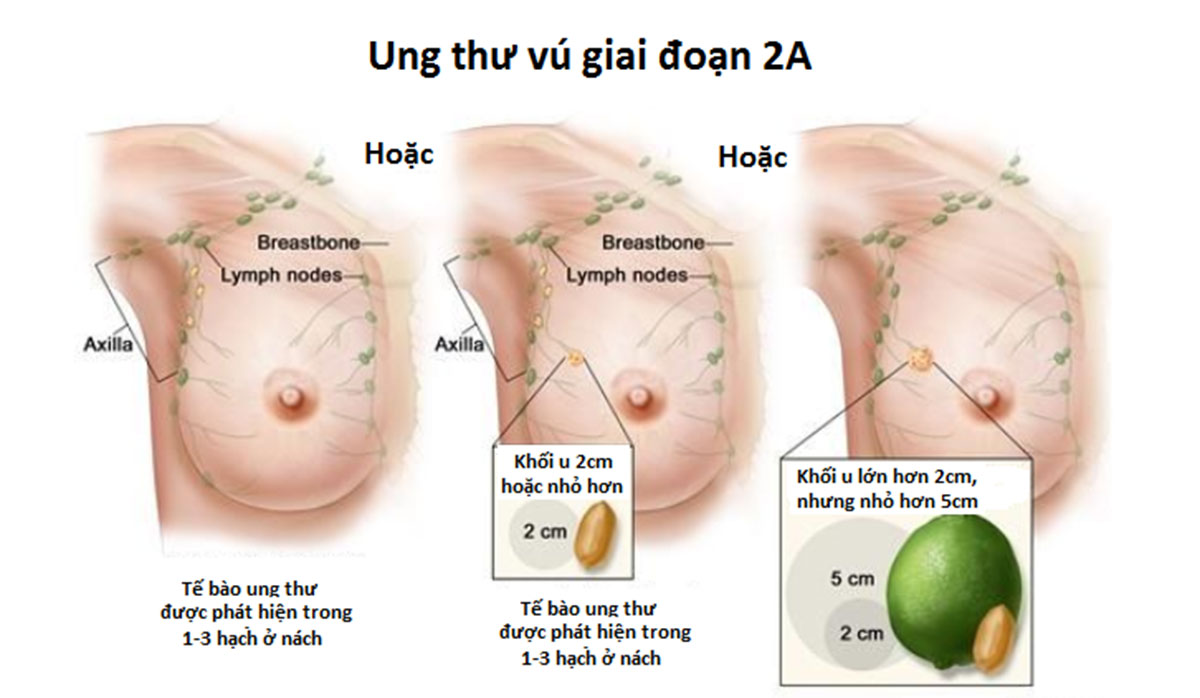 dieu-tri-ung-thu-vu-17