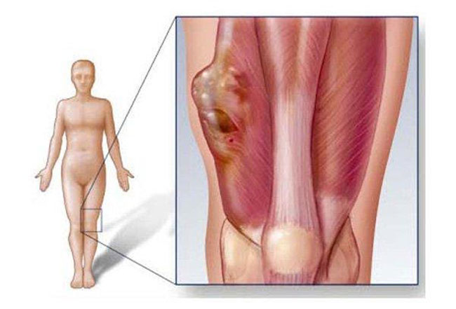 sarcoma-mo-mem-1