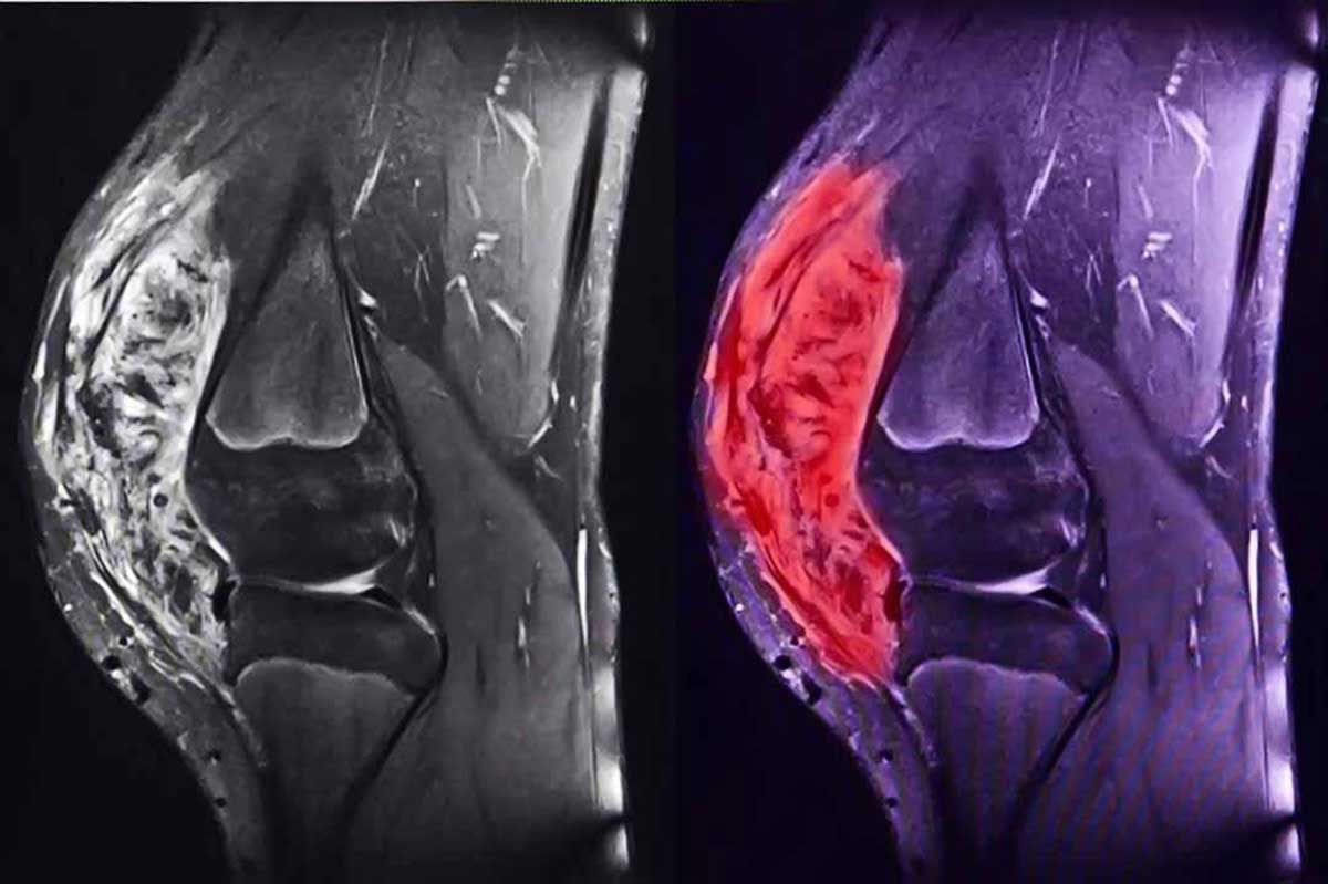 sarcoma-mo-mem-3