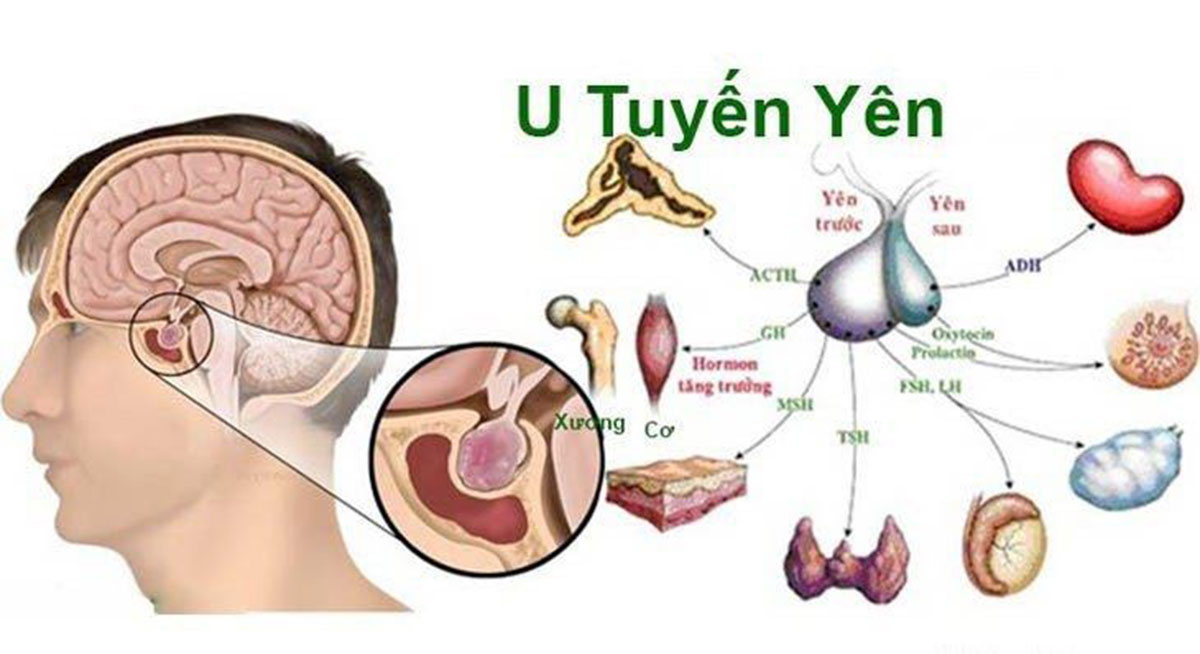 u-tuyen-yen-lanh-tinh-1