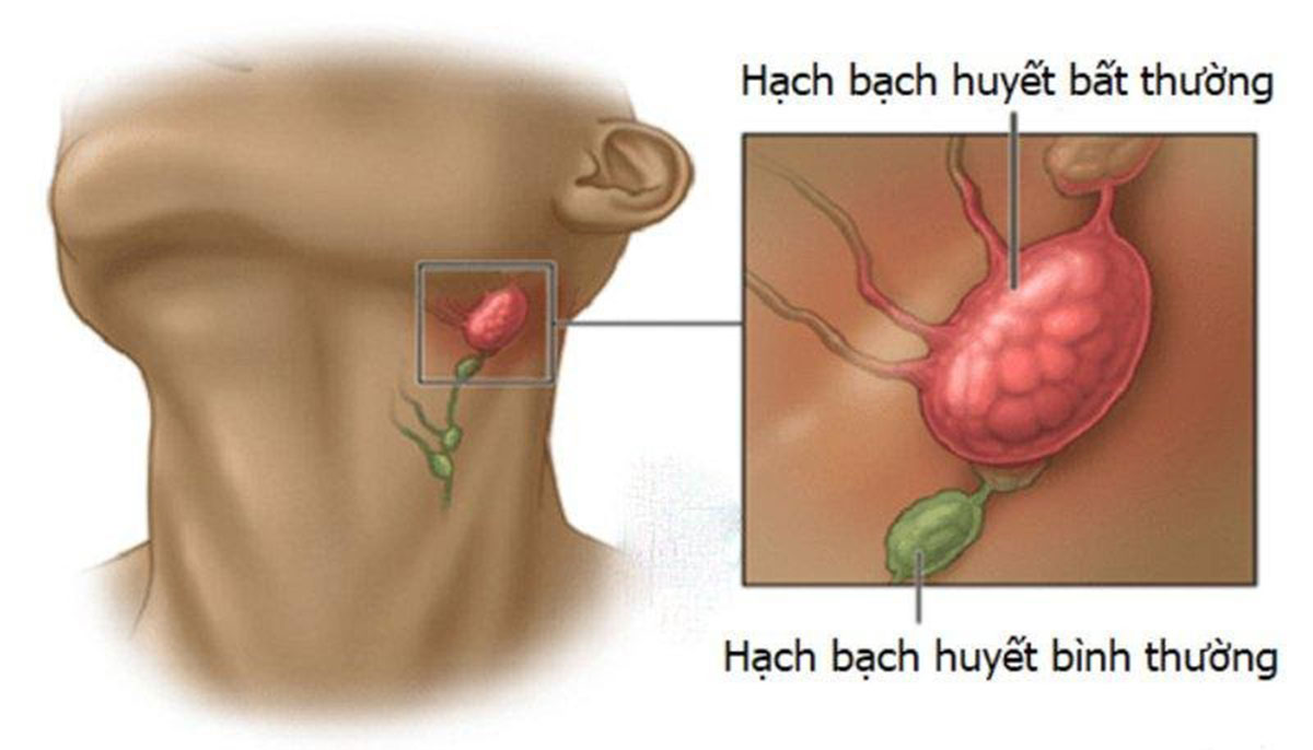 ung-thu-hach-bach-huyet-1