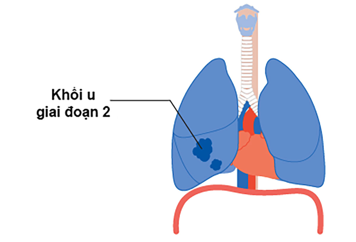 ung-thu-phoi-giai-doan-2_1