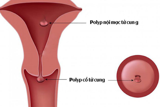 polyp-co-tu-cung-1