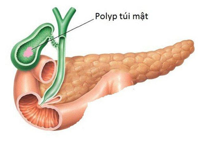 polyp-tui-mat-co-tu-het-khong-1