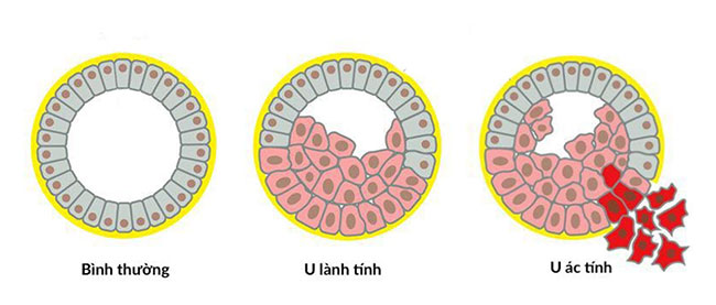 u-lanh-tinh-co-can-xa-tri-khong-1