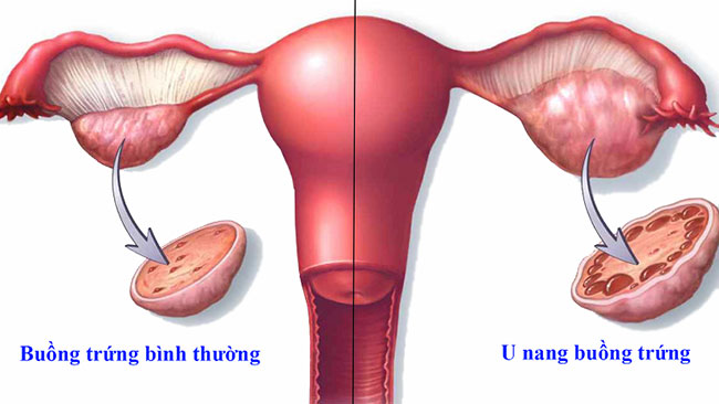 u-nang-buong-trung-co-phai-mo-khong-1