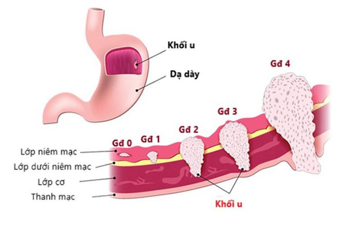 ung-thu-da-day-giai-doan-2-1