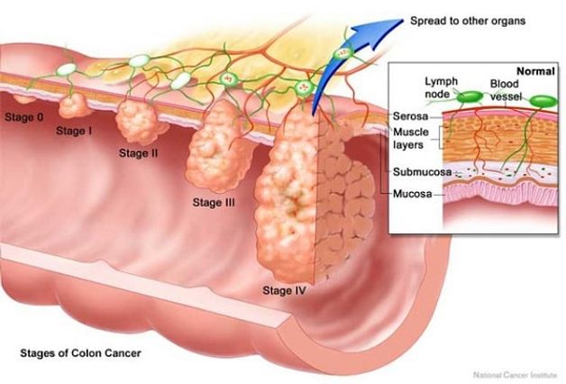 Ung thư đã phát triển đến lớp dưới niêm mạc hoặc lớp cơ của thành ruột và lan rộng sang 1-3 hạch bạch huyết vùng hoặc đã lan đến các mô gần hạch bạch huyết