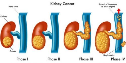 Các giai đoạn tiến triển ung thư thận