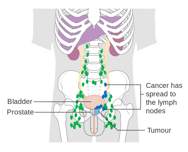 Ung thư tuyến tiền liệt có khả năng di căn đến hạch vùng và các cơ quan xa
