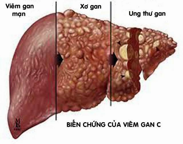 Viêm gan C nếu không điều trị có thể dẫn tới nhiều biến chứng nguy hiểm, trong đó có các bệnh ung thư như ung thư gan.