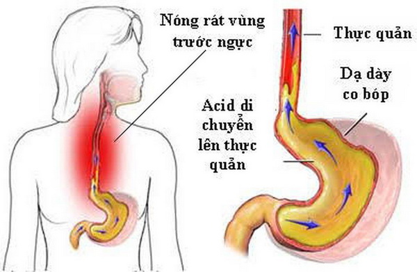 Nóng rát thực quản thường do dịch acid từ dạ dày trào vào thực quản dưới