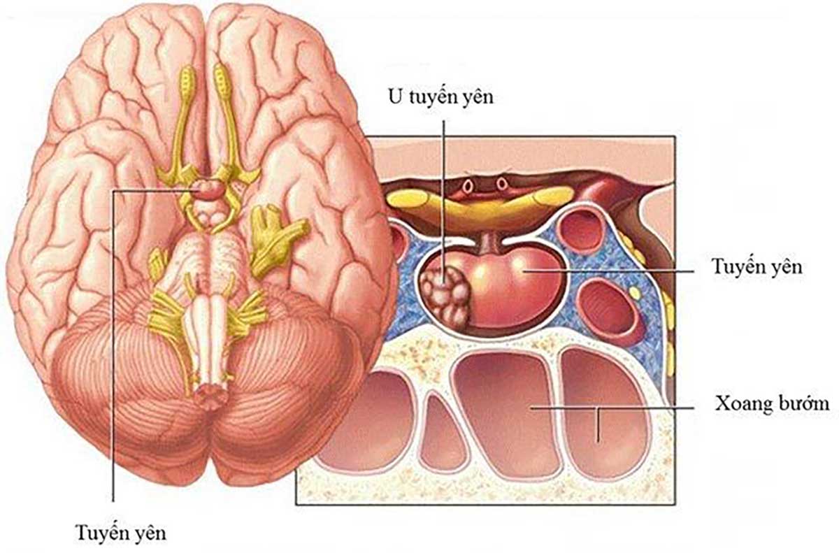 u-tuyen-yen-co-nguy-hiem-khong-1