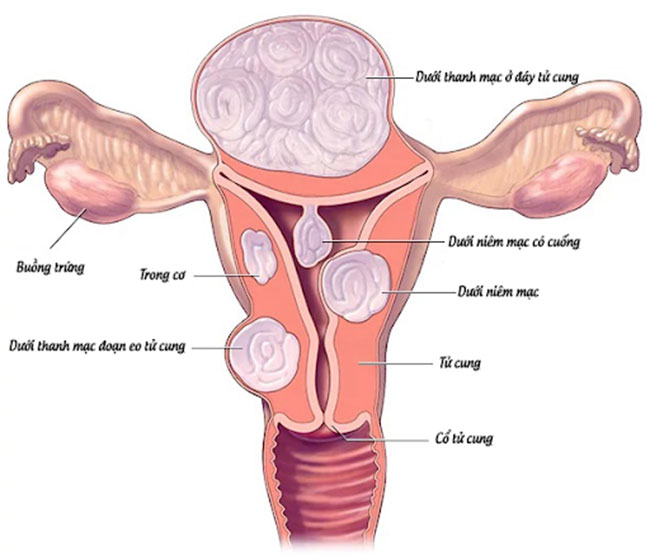 u-xo-tu-cung-co-di-truyen-khong-1