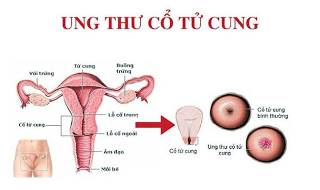 ung-thu-co-tu-cung-co-mang-thai-duoc-khong-1