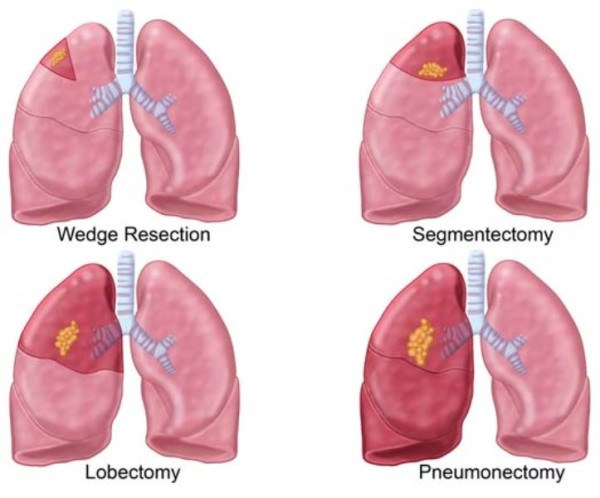 Phẫu thuật ung thư phổi