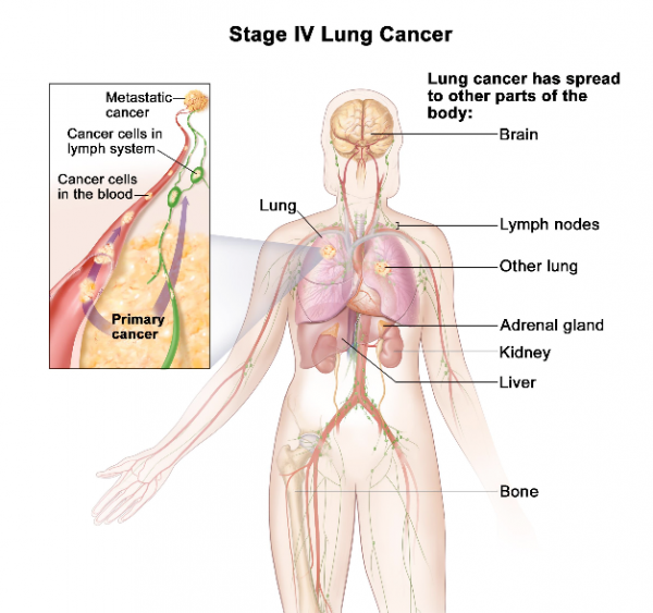 Ung thư phổi giai đoạn cuối có khả năng di căn rộng đến các cơ quan như não, xương, gan…