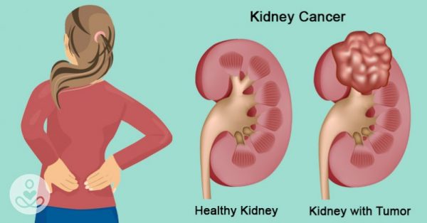 Ung thư thận có chữa được không phụ thuộc nhiều yếu tố