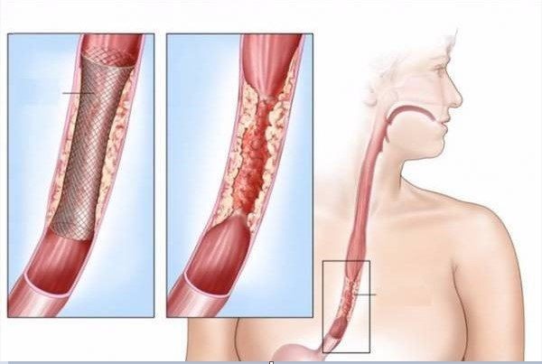 Ung thư thực quản có chữa được không?