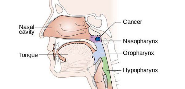 Ung thư vòm họng là bệnh ung thư bắt đầu ở mũi họng, phần trên của họng phía sau mũi và gần hộp sọ