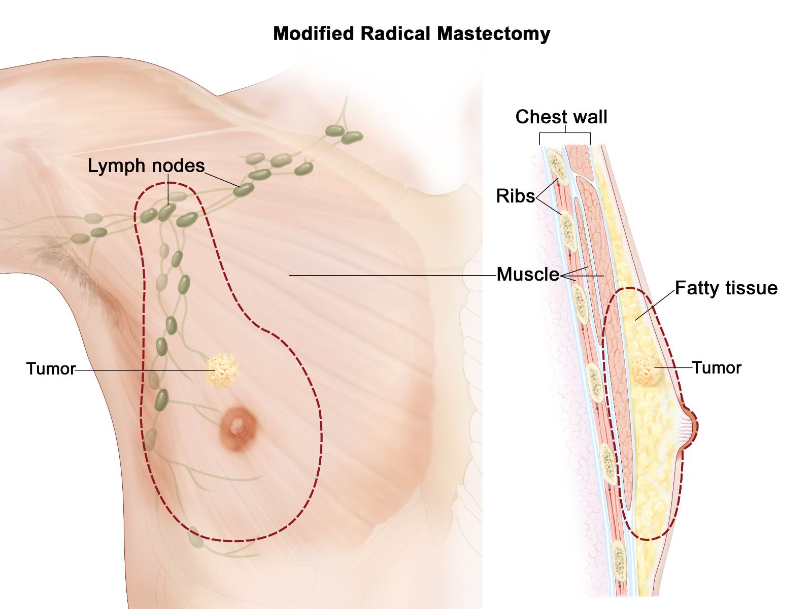 Một cục u ở vú - thường là đau hoặc không đau và không di động cảnh báo ung thư vú ở nam giới