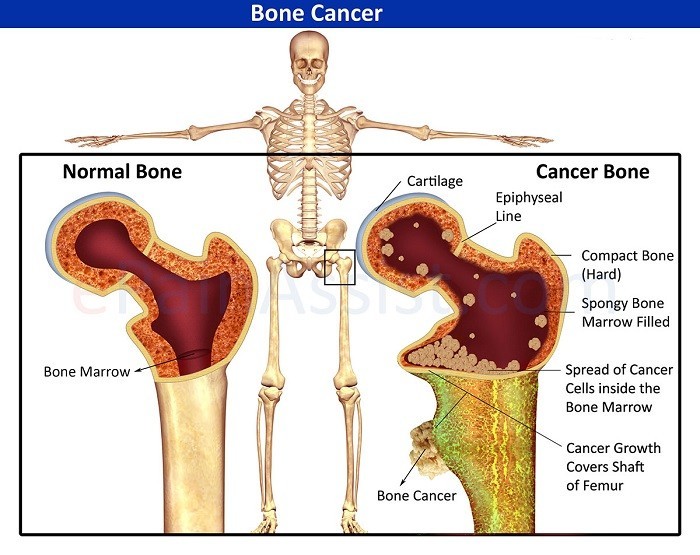 Ung thư xương