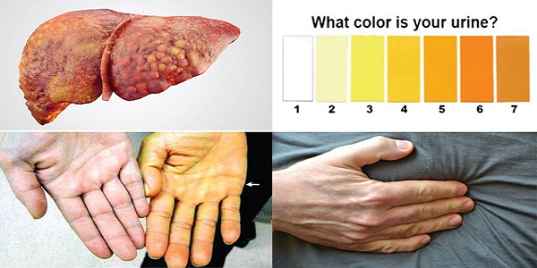 Vàng da, vàng mắt là triệu chứng thường gặp khi khối u di căn gan