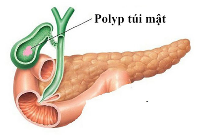 bi-polyp-tui-mat-nen-kieng-an-gi-1