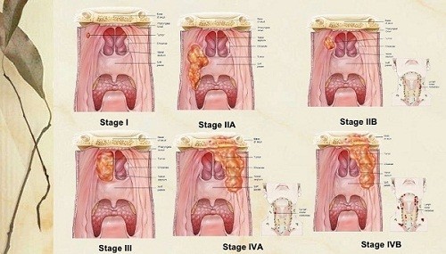 Các giai đoạn hình ảnh ung thư vòm họng cho thấy mức độ nguy hiểm của bệnh nên cần được điều trị cần kiên trì, liên tục.